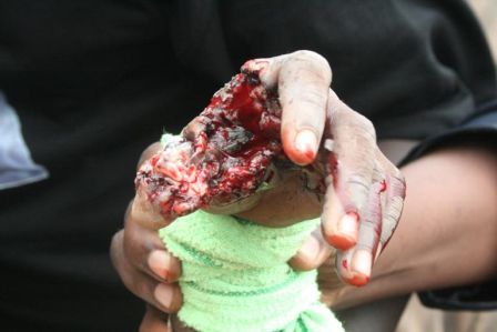 Child showing injuries resulting from the device he was carrying