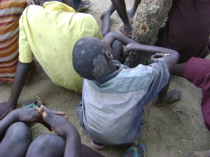 Photos of children with skull diseases got infected on the run from LRA rebels (By Richard Ruati -ST)