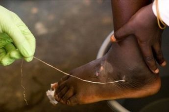 In this Friday, March 9, 2007 file photo, a Guinea worm is extracted by a health worker from a child's foot at a containment center in Savelugu, Ghana (AP)