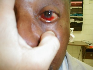 Red Eye patient (University of California)