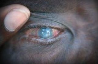 A  Sudanese woman suffering from trachoma is examined by a nurse (Tropika.net)