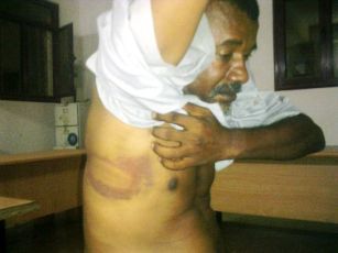 A photo of Ray al-Sha’b’s deputy editor-in-chief Abu Zar Ali Al-Amin showing bruises he sustained as a result of torture by Sudan’s security agents
