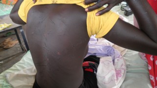 Agot Ngong Okha, showing her wounds after she was beaten, Bor private clinic, 1 March 2011 (ST)