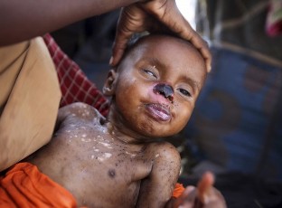 An internally displaced woman holds her malnourished son at a camp in Somalia's capital Mogadishu, July 27, 2011 (Reuters)