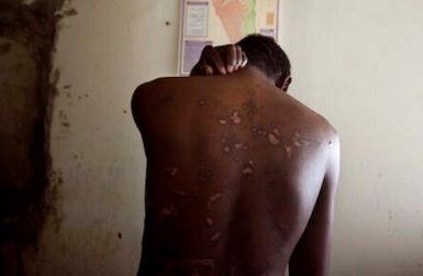 An Eritrean man trafficked from Sudan to Sinai shows the scars inflicted by his captors (AP)