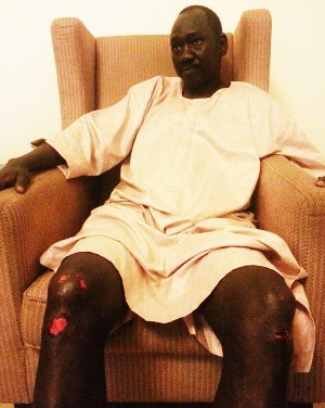 A Picture released by the SPLM-IO for its SG and Minister of Energy, Dhieu Mathok Diing Wol, after he was beaten by South Sudan security, Juba, 14 July 2016.