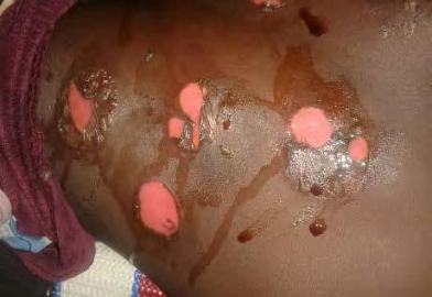 In this photo released by Amnesty, the skin of this victim’s back shows multiple circular wounds that appear to be from freshly popped blisters revealing fresh pink skin. According to the group, these circular wounds are consistent with exposure to a chemical warfare blister agent such as sulphur mustard. (Amnesty Photo)