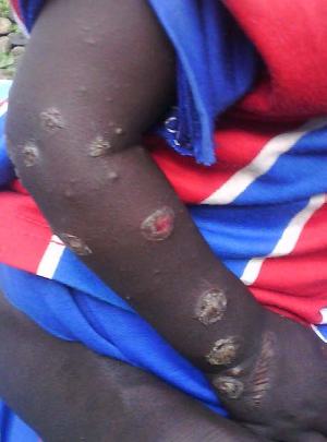 A child's arm shows off circular wounds consistent with chemical poisoning  (Amnesty International photo)