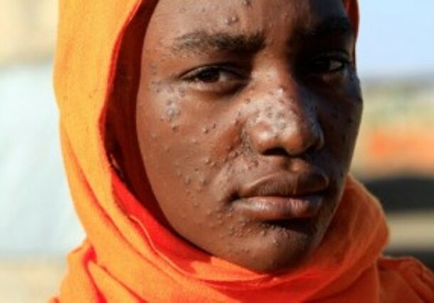 This woman’s rash is symptomatic of kala-azar, a parasitic disease spread by sandfly bites in the tropics (Reuters photo)