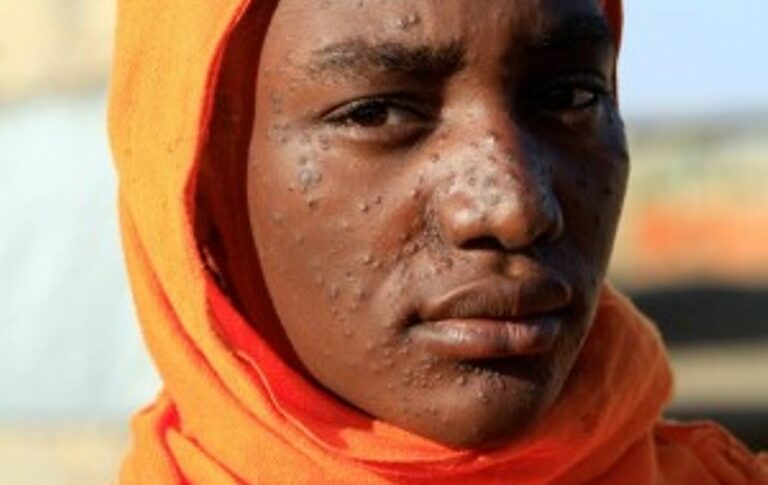 This woman’s rash is symptomatic of kala-azar, a parasitic disease spread by sandfly bites in the tropics (Reuters photo)